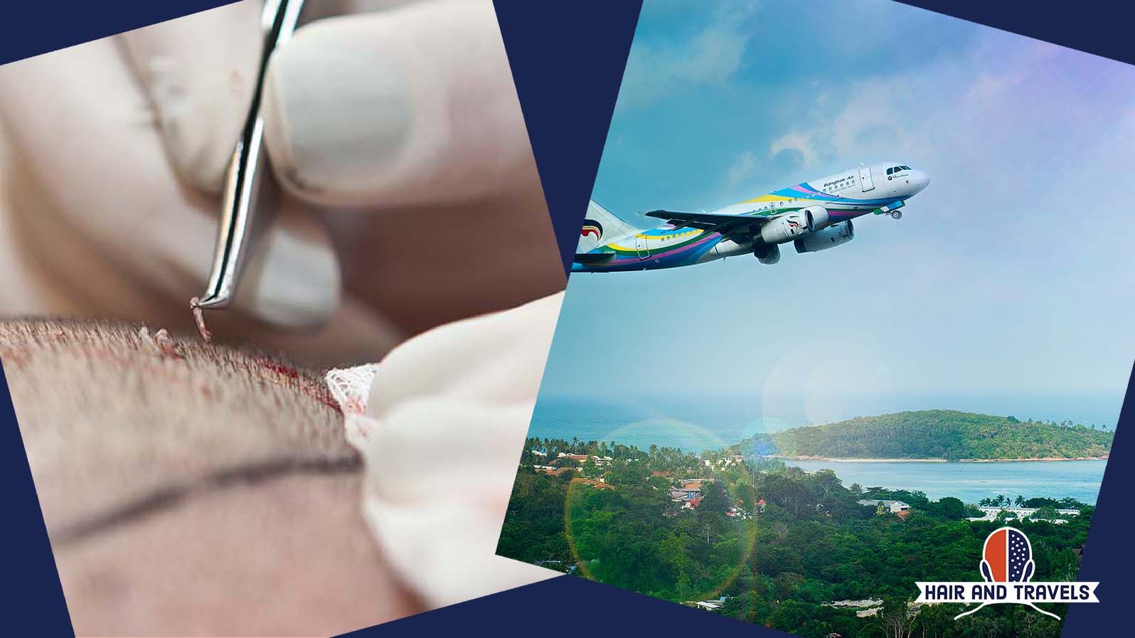 travel after hair transplant