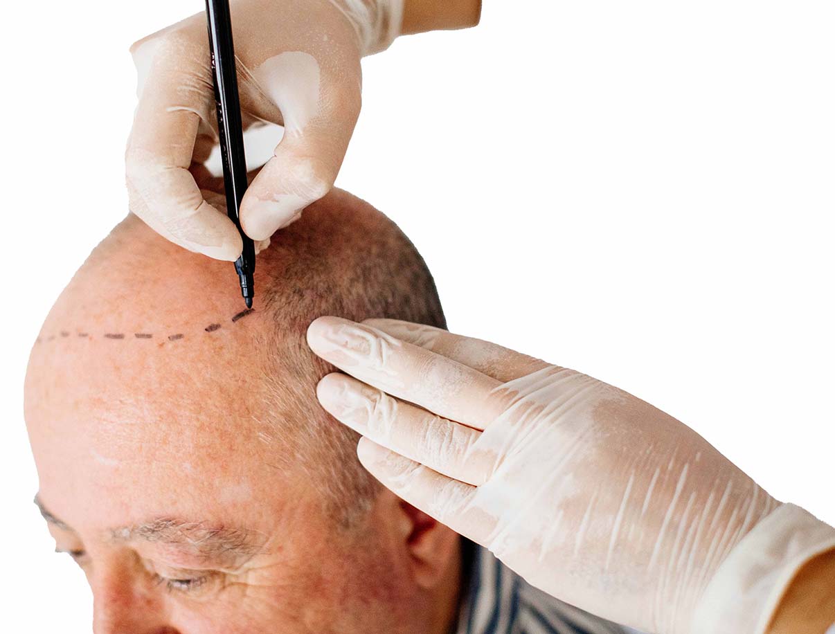 خدمة زراعة الشعر