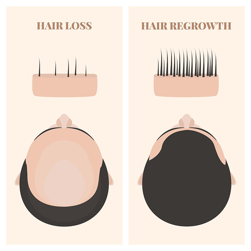 إعادة نمو الشعر