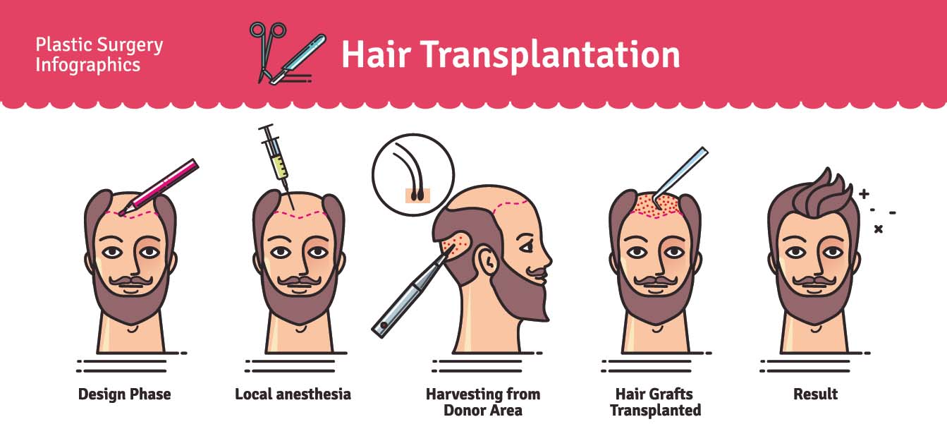 Phasen der Haartransplantation
