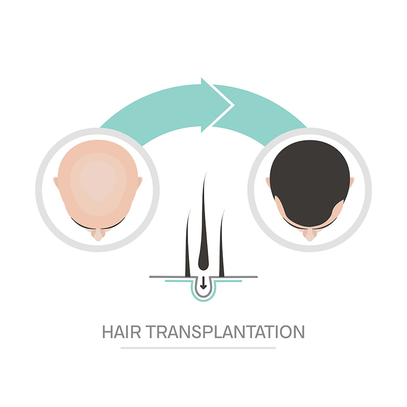 Schritt-für-Schritt-Haartransplantationsprozess