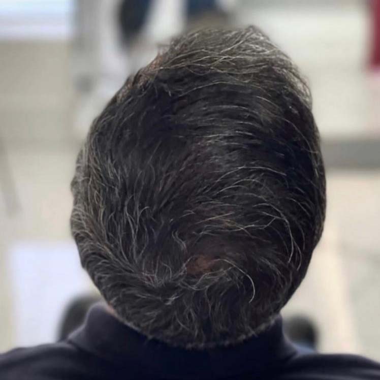 greffe de cheveux avant après résultat