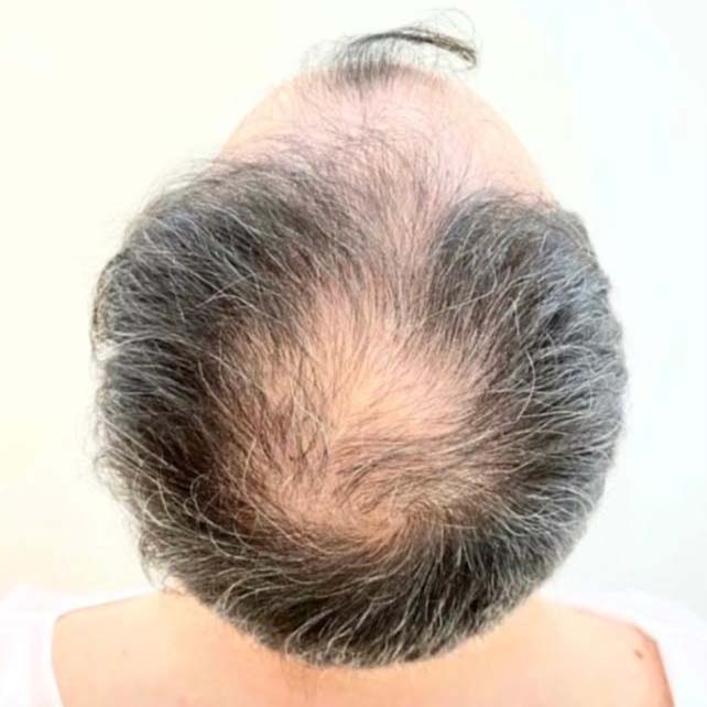 زراعة الشعر قبل النتيجة