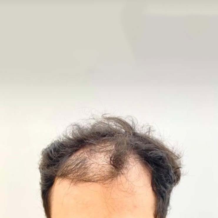 greffe de cheveux avant après résultat