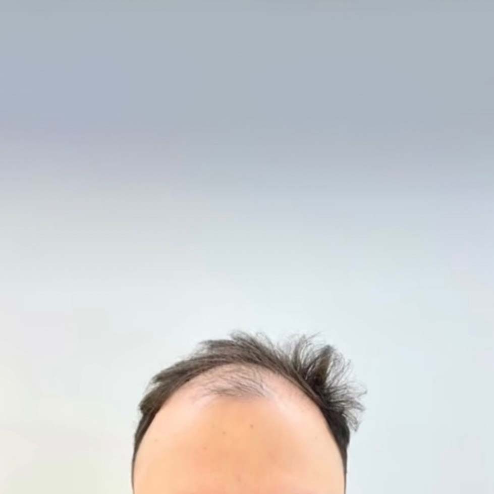 hair transplant before-after